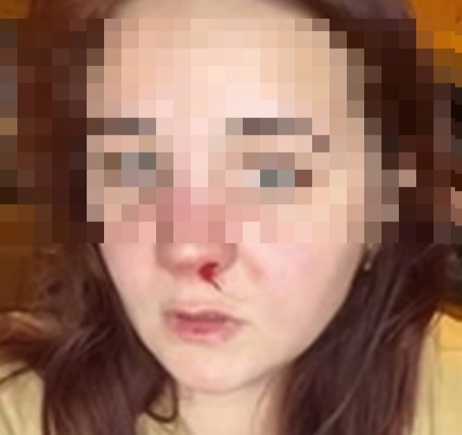 Соцсети: нижегородец сломал нос девушке в лифте - фото 1